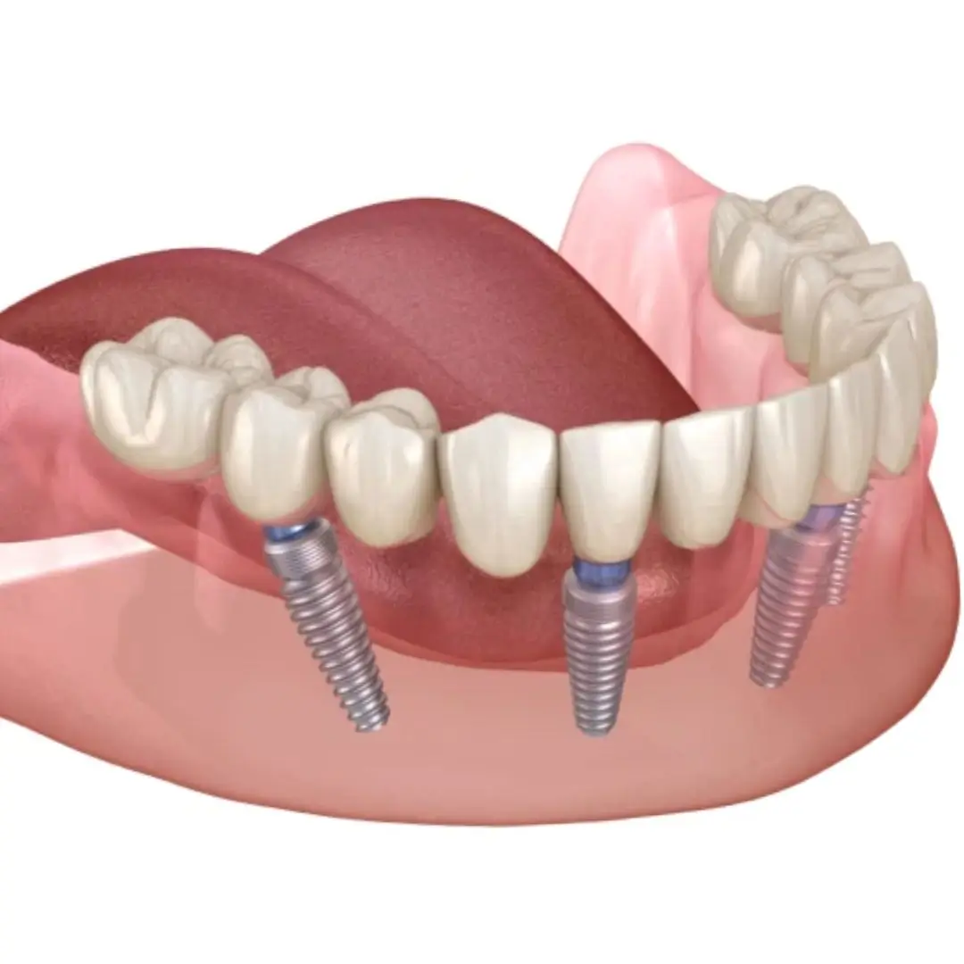 All on X dental Implant Dentist Essendon