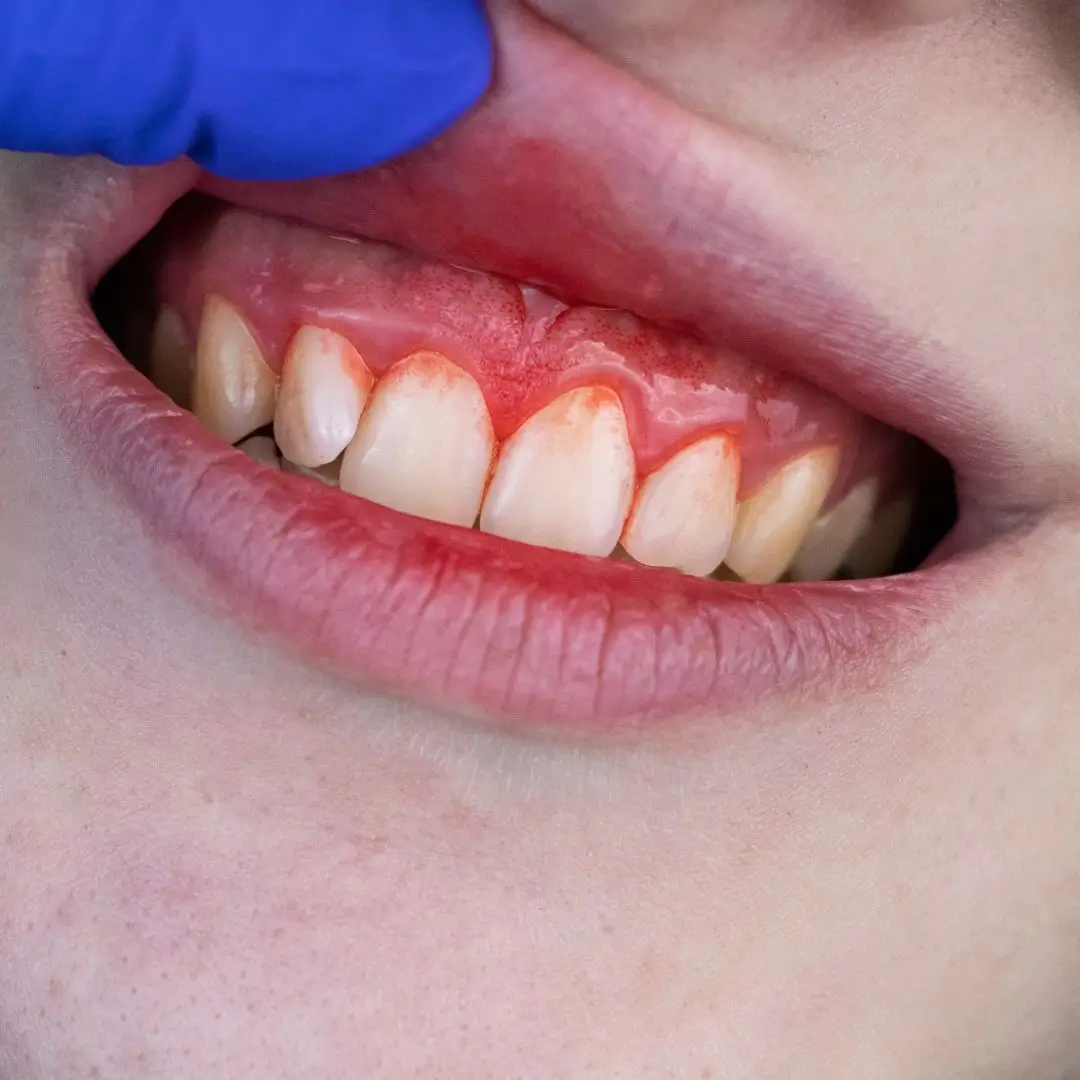 Bleeding of the gums