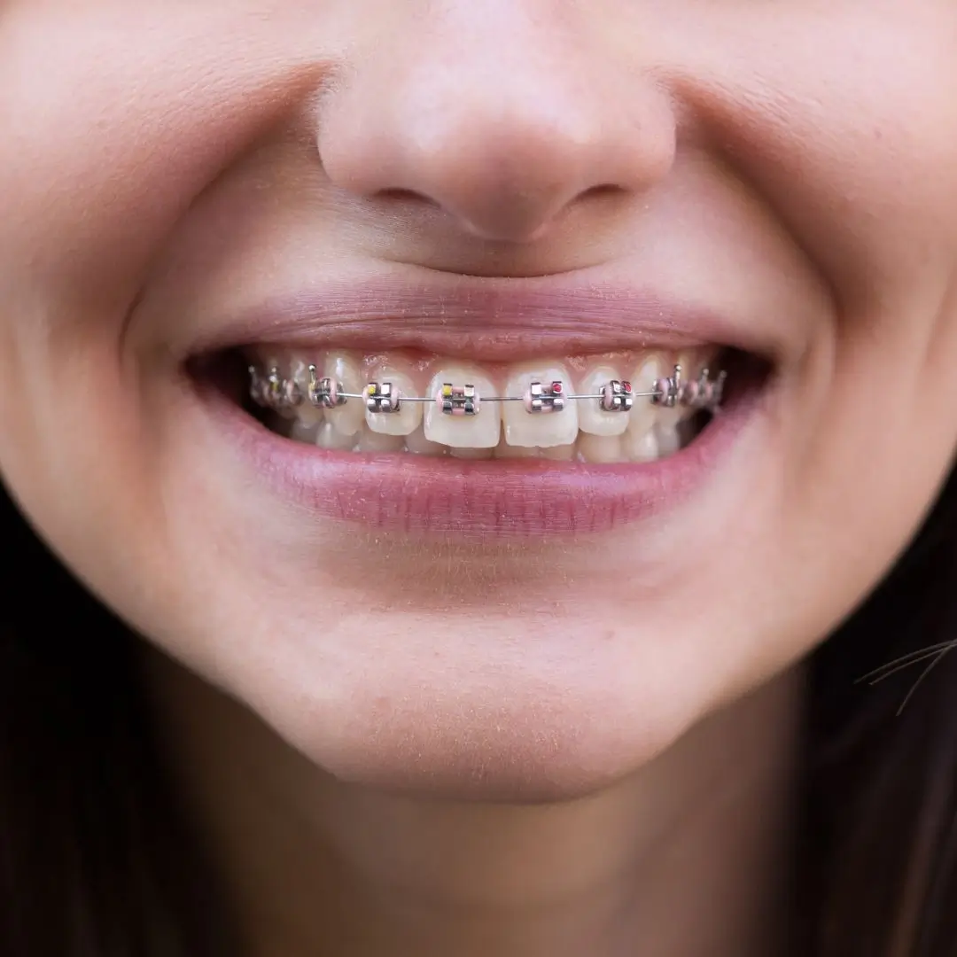 Braces (1)