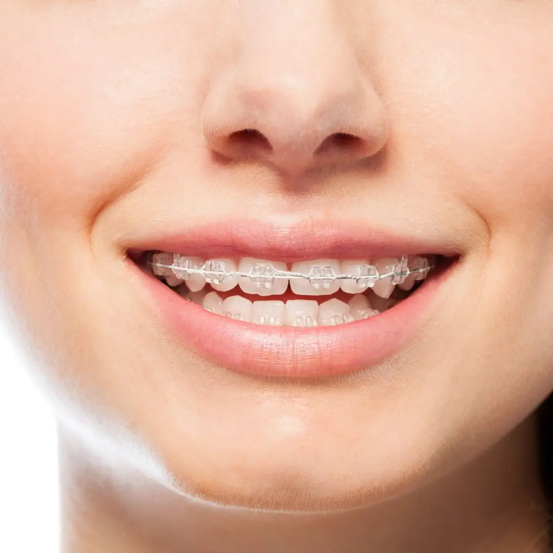 Ceramic Braces dentist Essendon
