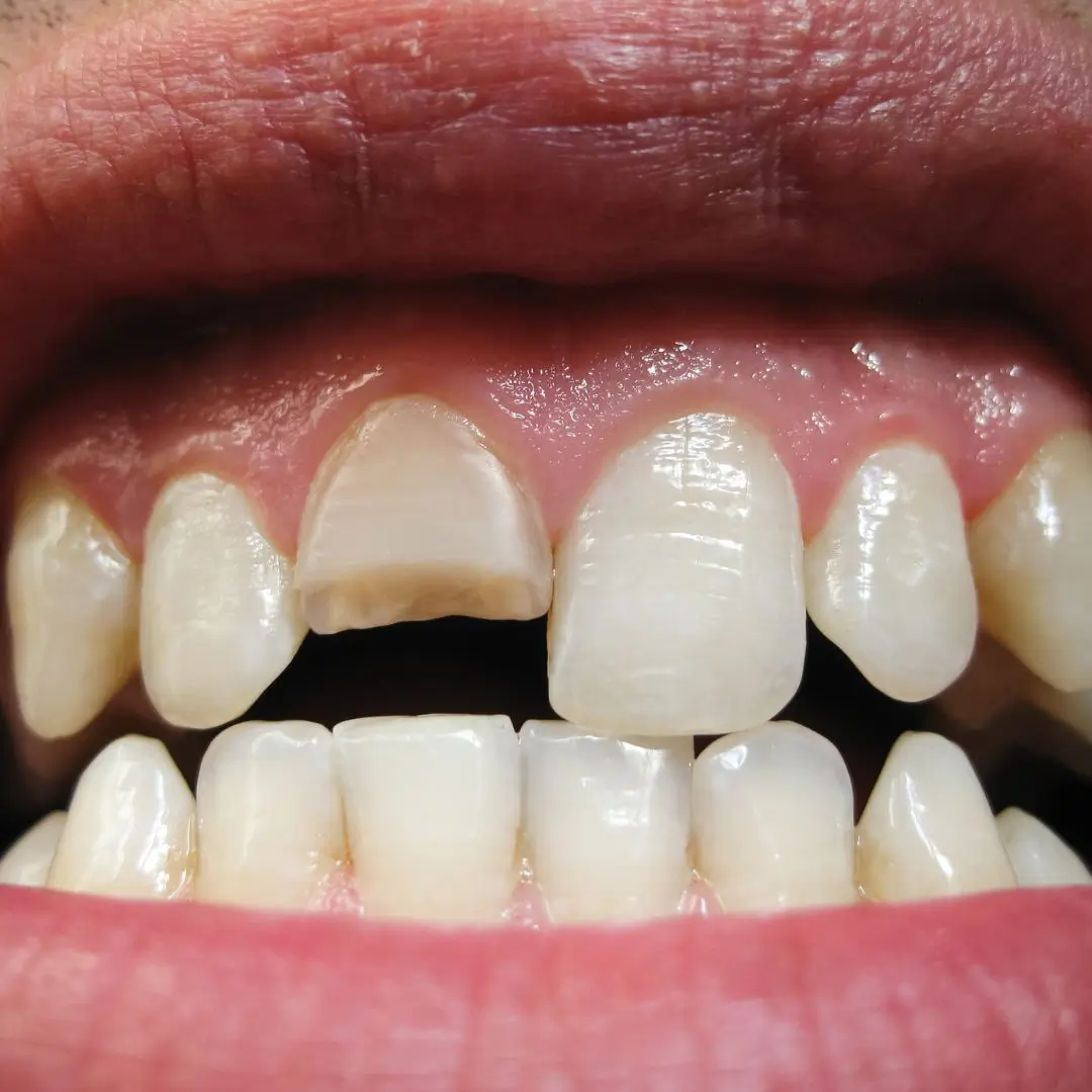 Chipped Tooth Treatment Essendon
