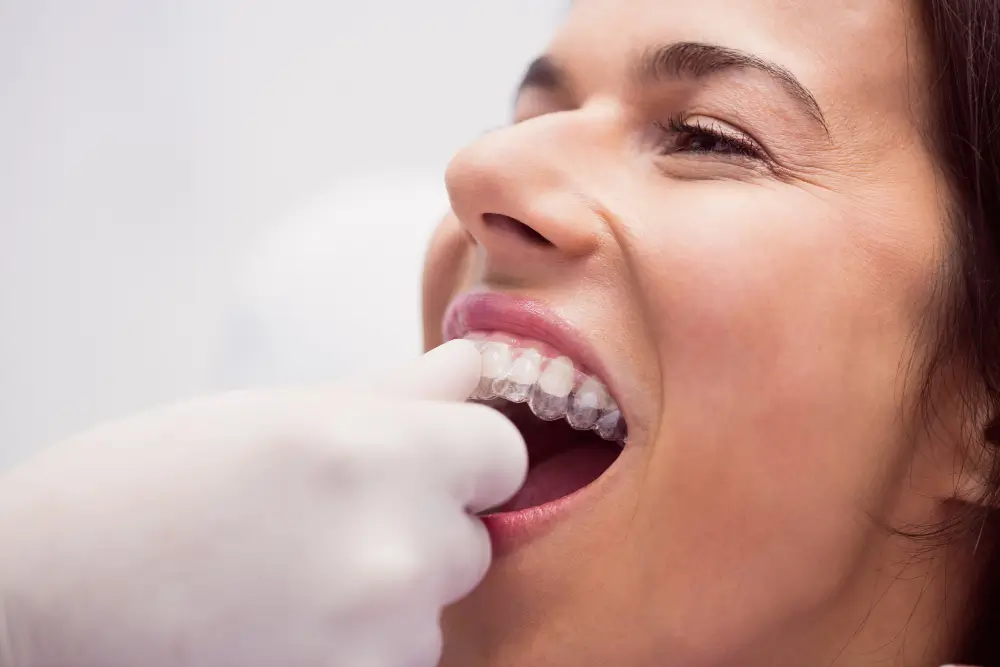 Clear Aligners Dentist Essendon
