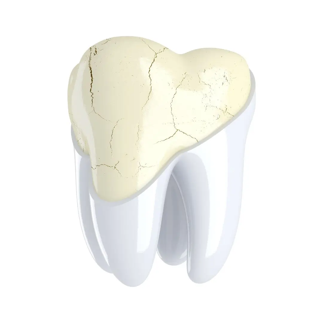 Cracked Tooth Treatment Essendon