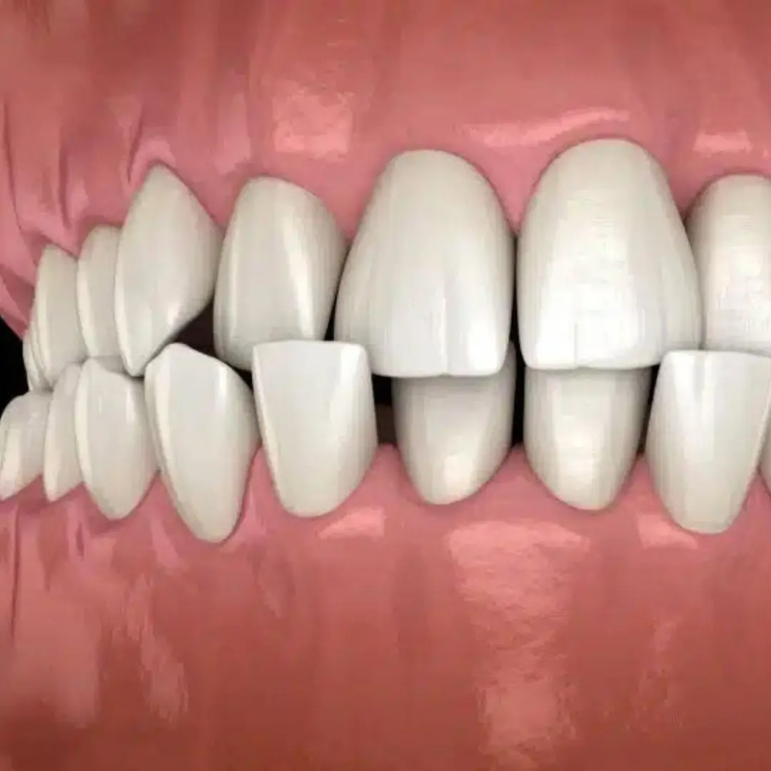 Crossbite