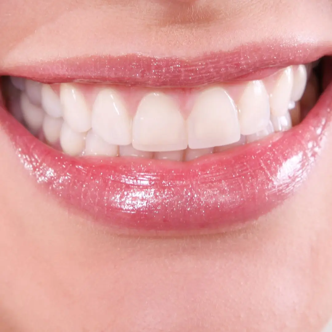 Dental Porcelain Indirect Fillings Dentist Essendon
