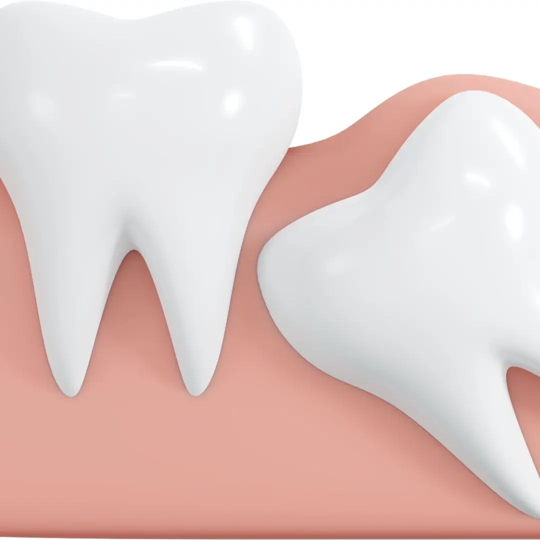 Impacted Teeth Wisdom Teeth Removal