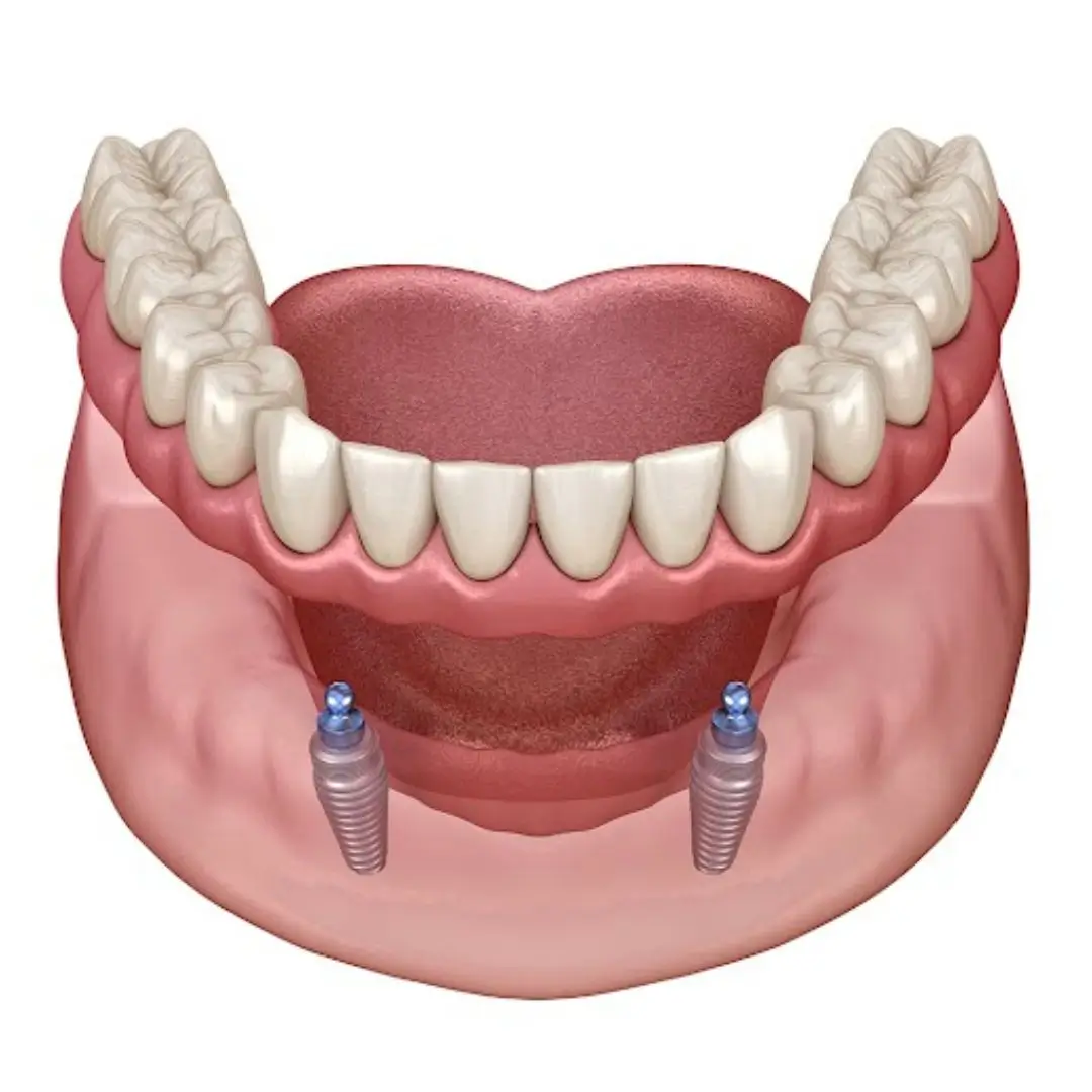 Implant Retained Dentures Snap on Dentures Dentist Essendon