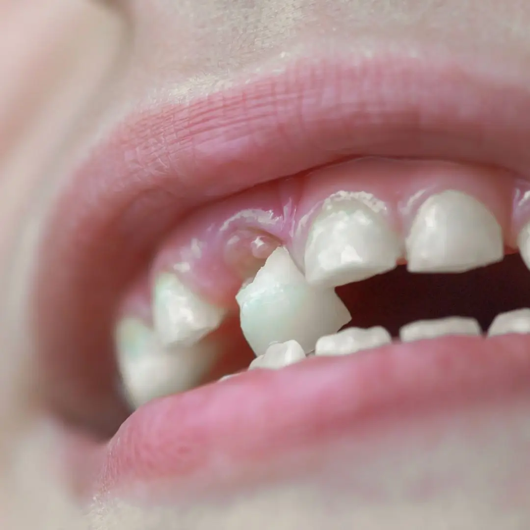 Knocked Out Teeth