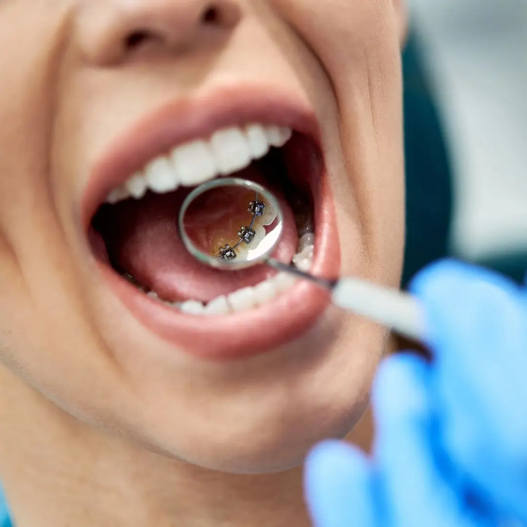 Lingual Braces dentist Essendon