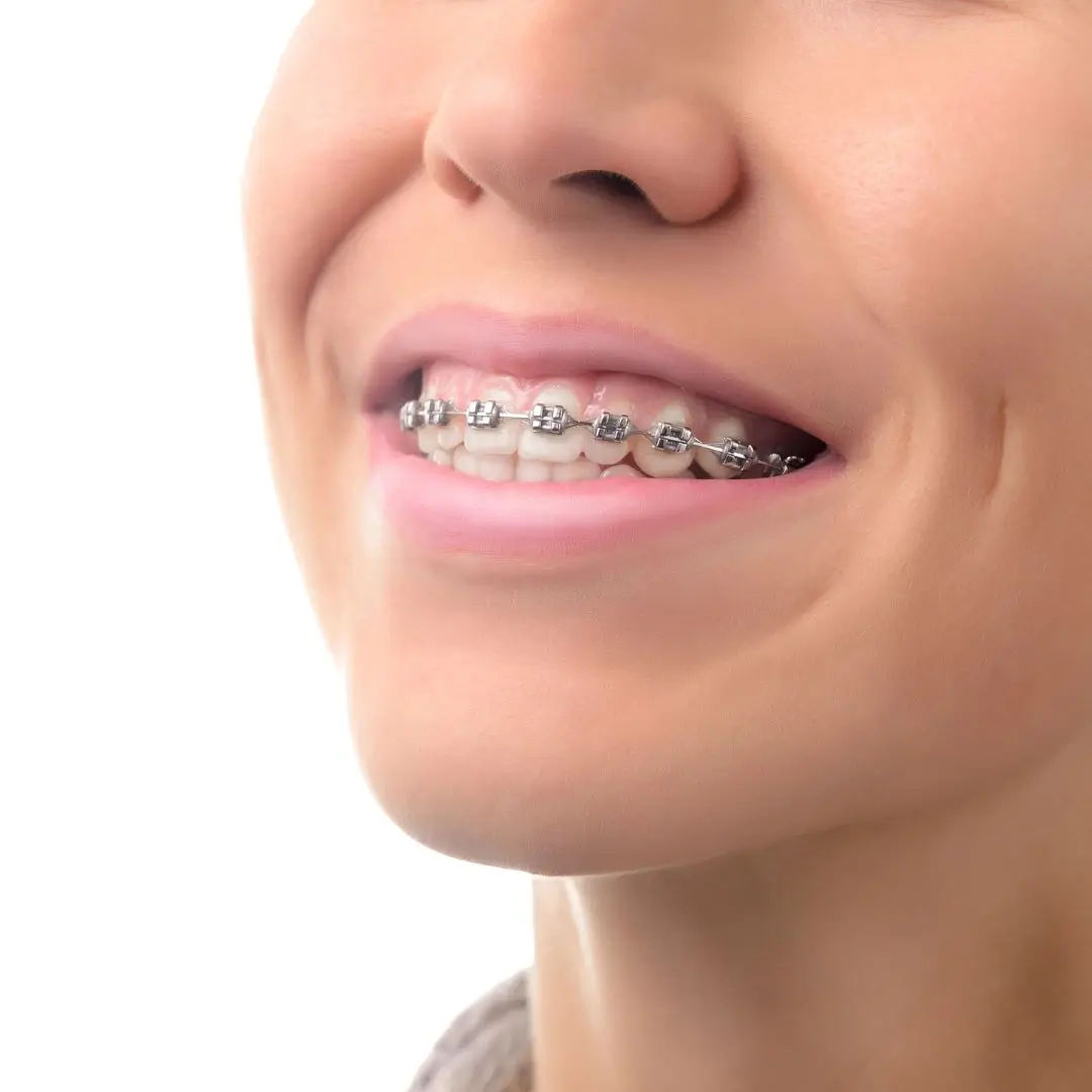 Metal Braces dentist Essendon