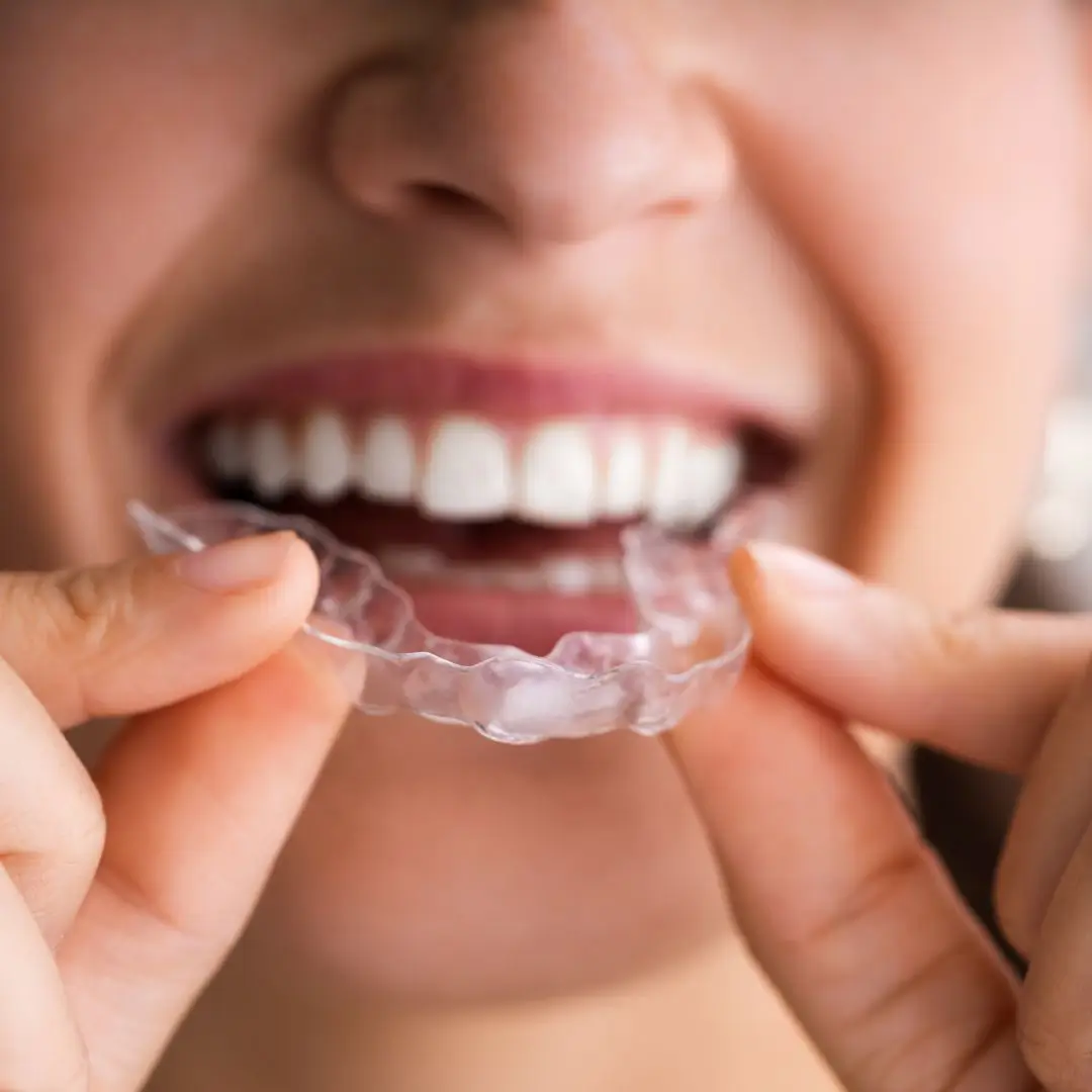 New Aligners
