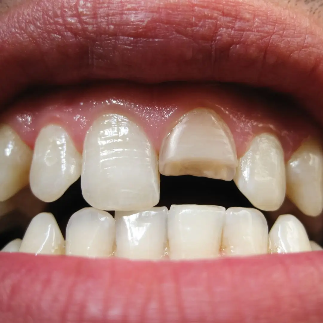 Providing Treatment For Cracked Chipped or Broken Teeth