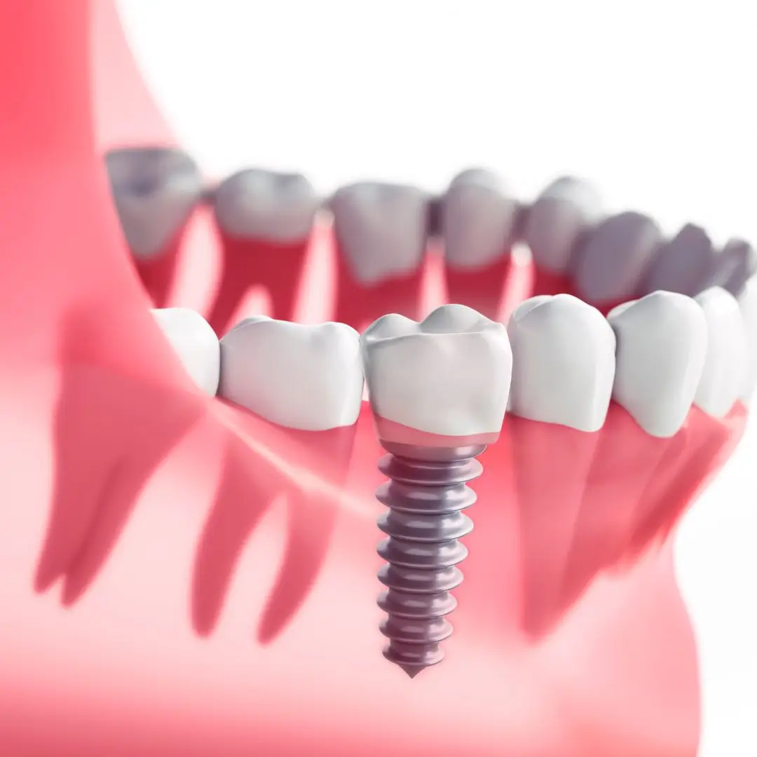 Single Dental Implants Dentist Essendon