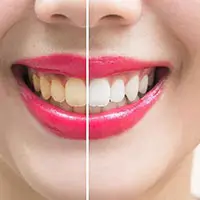 Stain Removal Dentist Essendonl