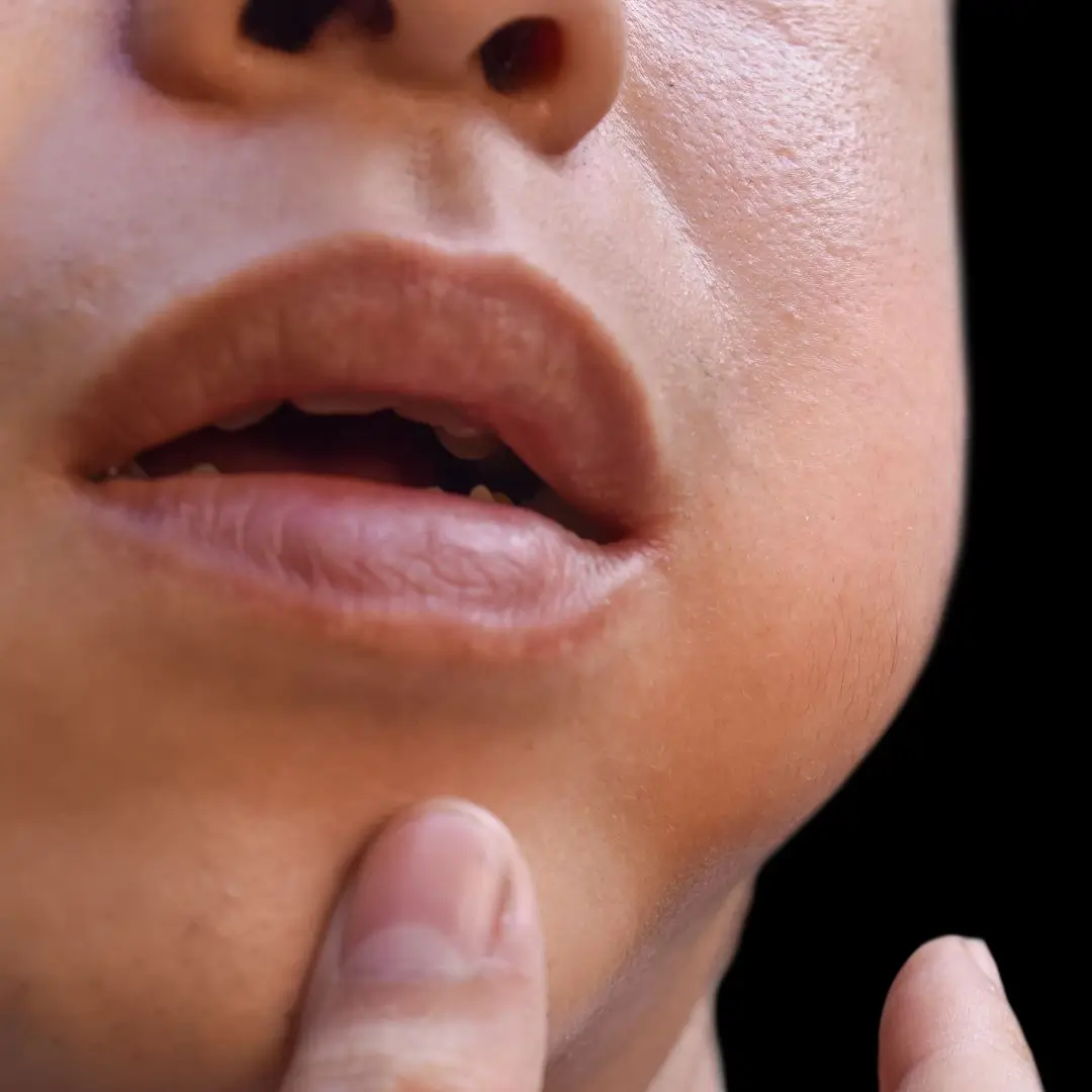 Swelling In The Gums
