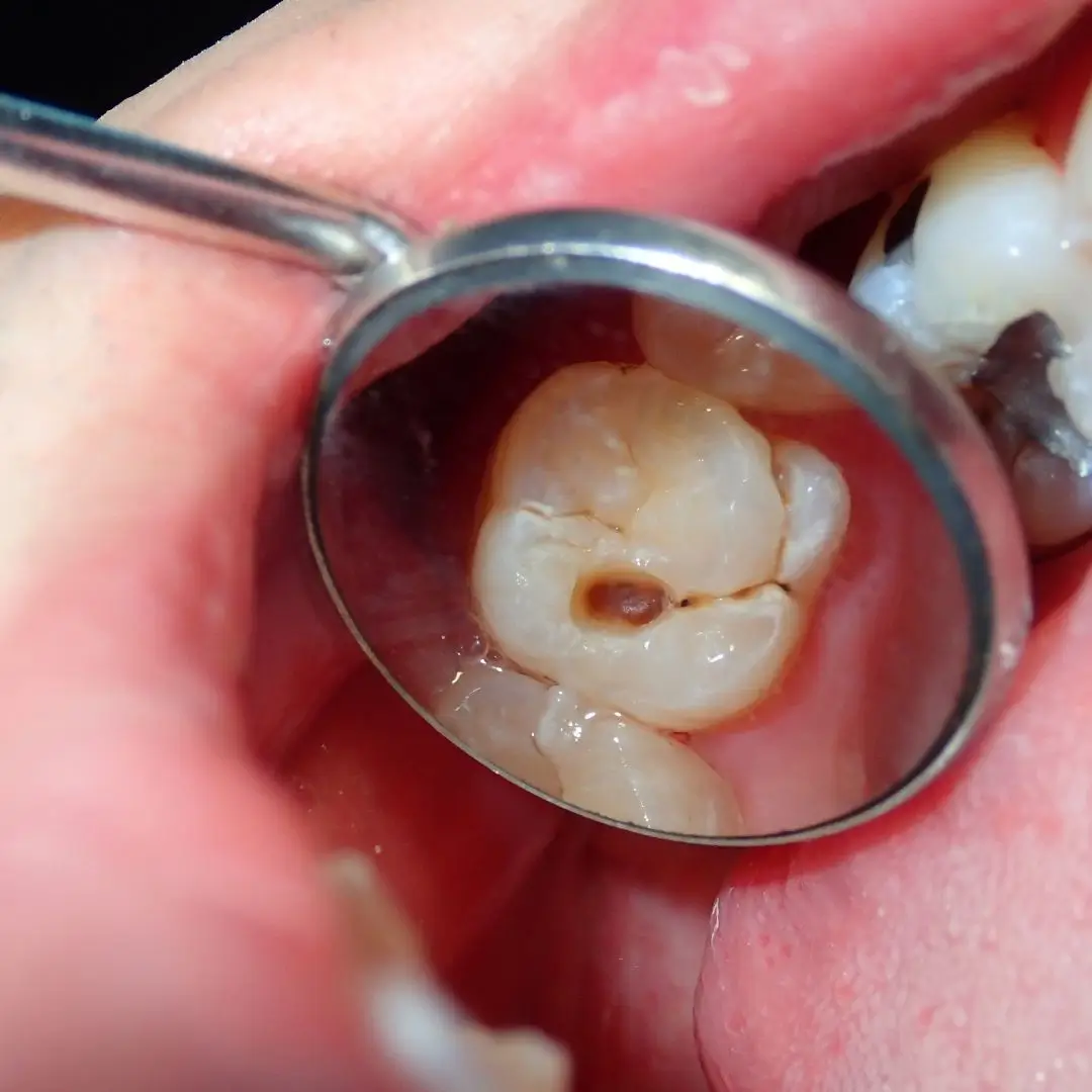 Teeth Cavities Due to Acid Attacks
