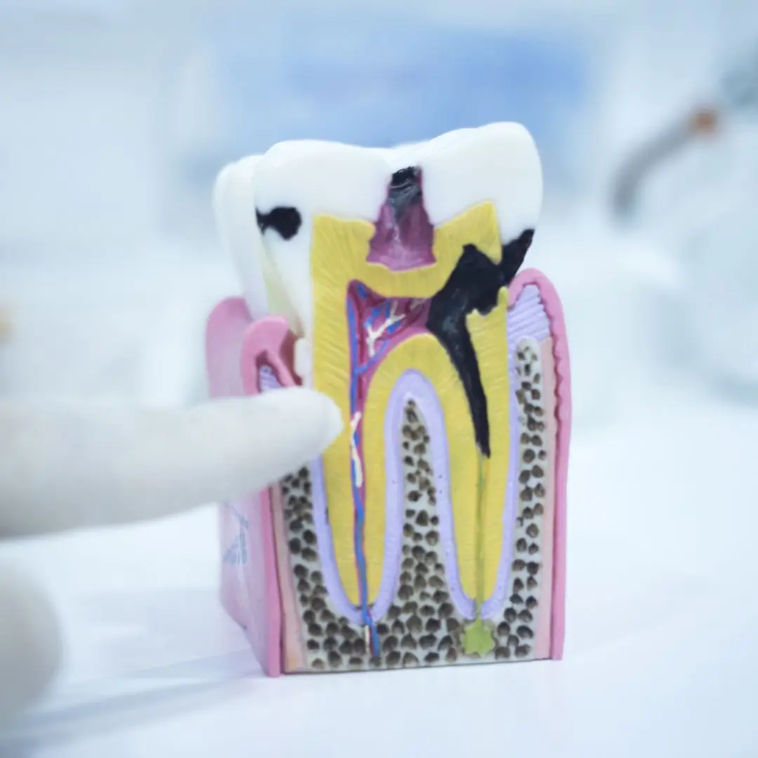 Tooth Decay Dentist Essendon 1