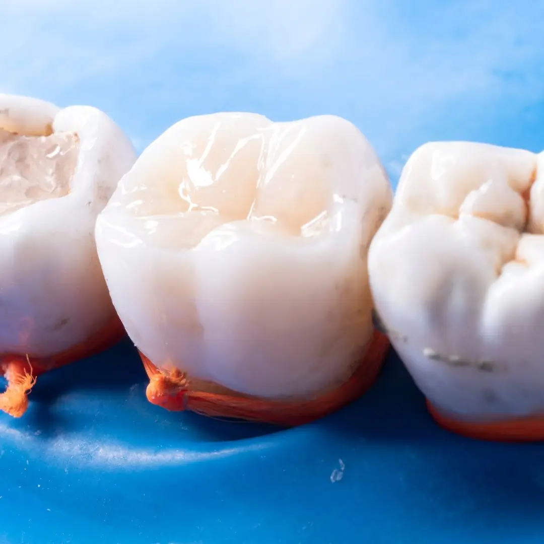 White Fillings – Composite Resin Essendon