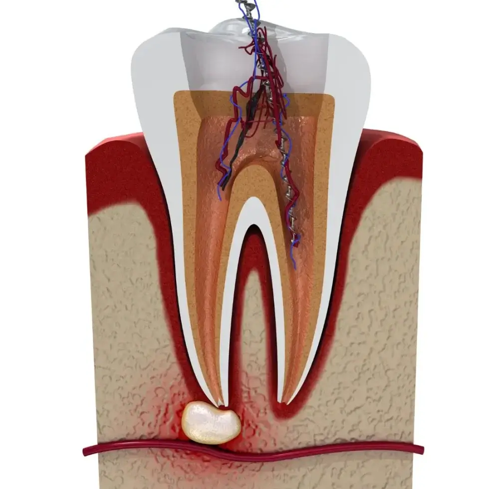 Emergency Root Canal Treatment