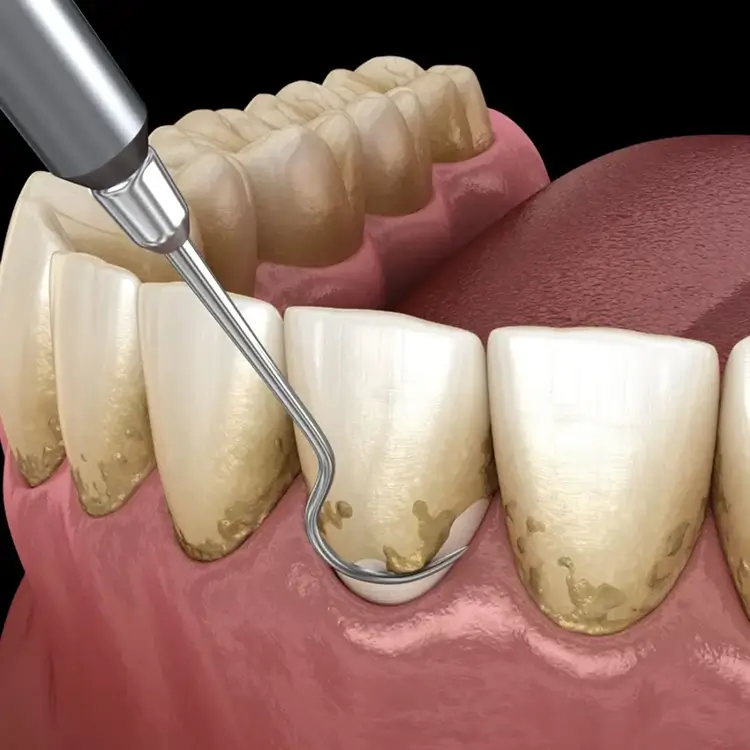Gingivitis Dentist Essendon