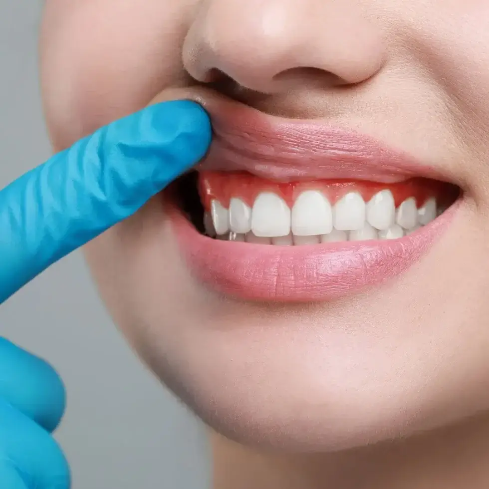 Gum Disease Treatment Essendon Dentist