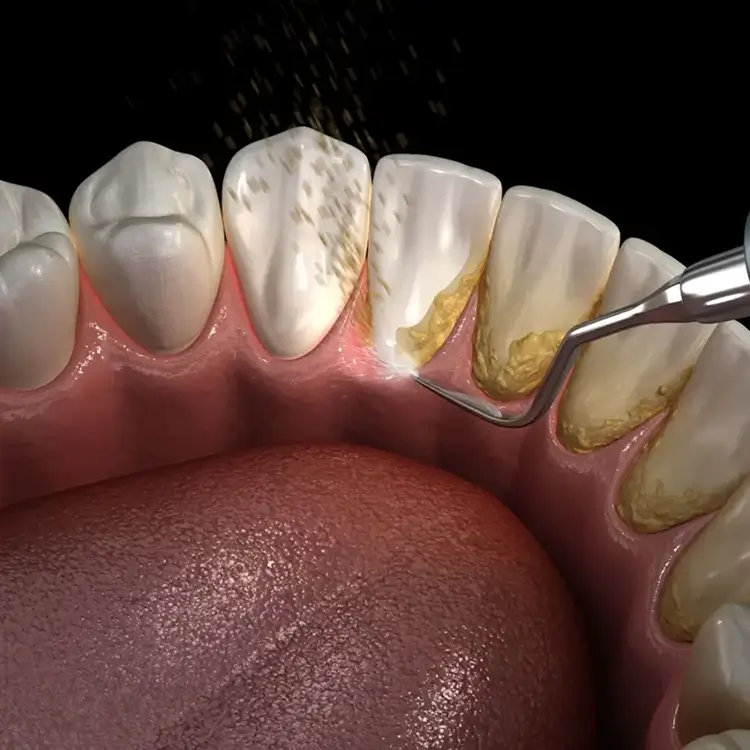 Periodontitis Dentist Essendon