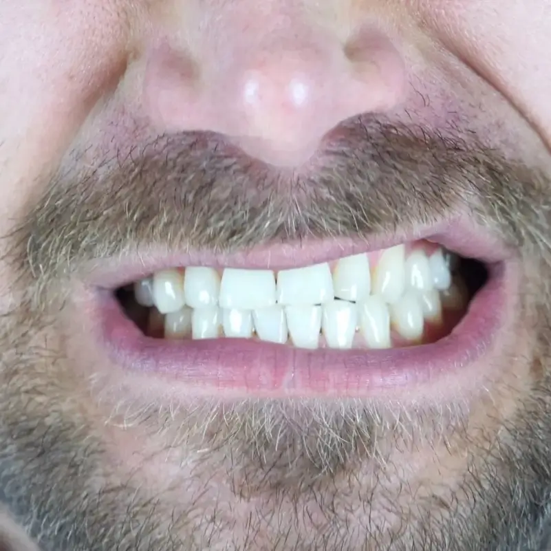 Teeth Grinding