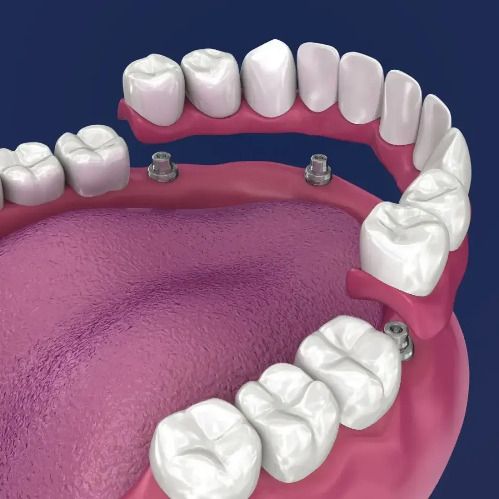 Teeth on 4 Teeth On 6 Dental Implants Essendon A Fast and Effective Solution for Full Jaw Restoration